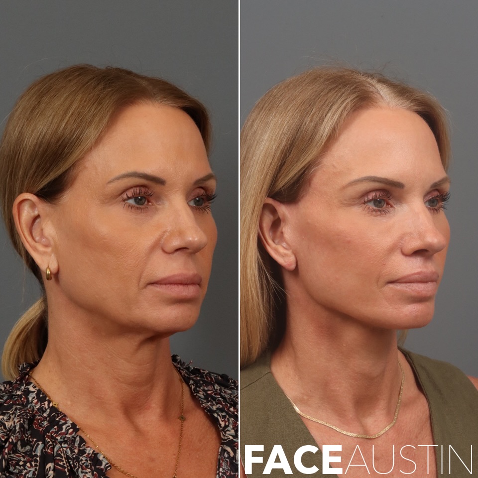 Instagram post by Dr. Marcelo Antunes: The jawline. The neck. The overall balance. At 53, this patient is six months post deep plane face & neck lift, temporal lift, fat transfer,…