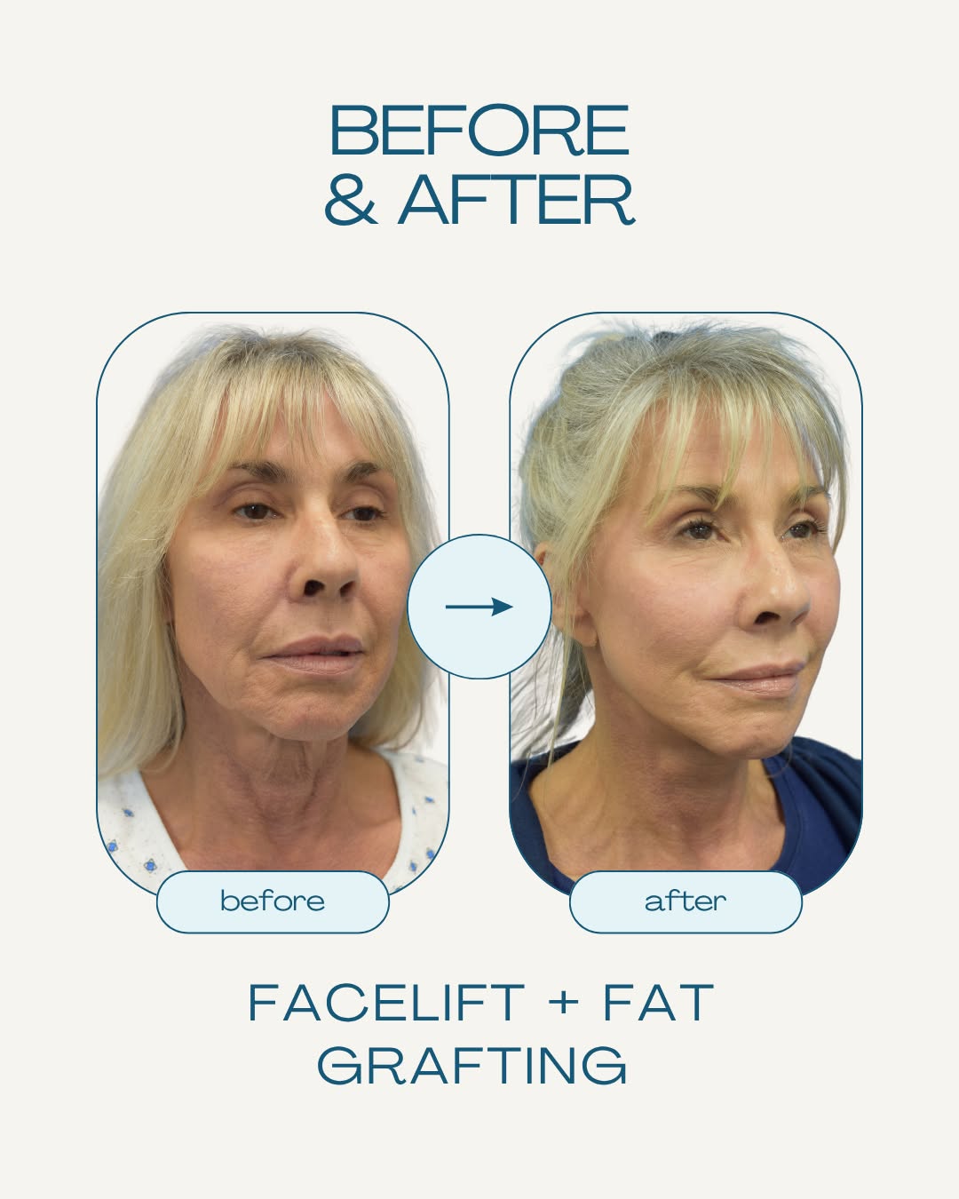 Instagram post by Dr. Marcelo Hochman: The Facial and Body Surgery Center: results that speak for themselves. Contact us today to book a consultation!
