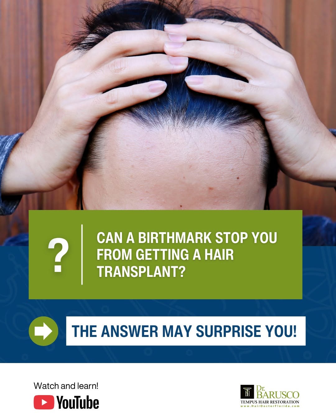Instagram post by Dr. Marco Barusco: Can a birthmark stop you from getting a #HairTransplant? The answer may surprise you! Dr. Marco Barusco explains how hair can be successfull…