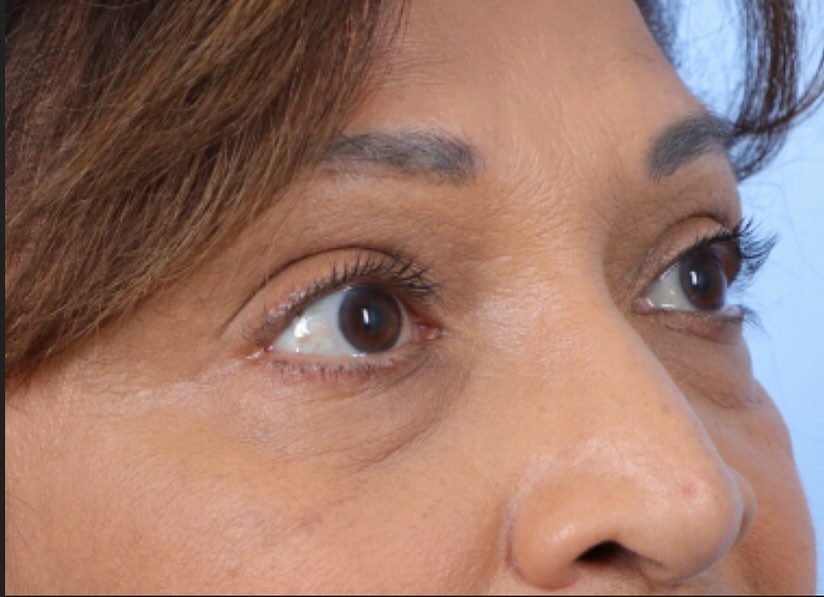 Instagram post by Dr. Marco Ellis: Bags or fat pads under the lower eyes can make a person look tired. Lower blepharoplasty helps by removing this extra fatty tissue. Call 312…