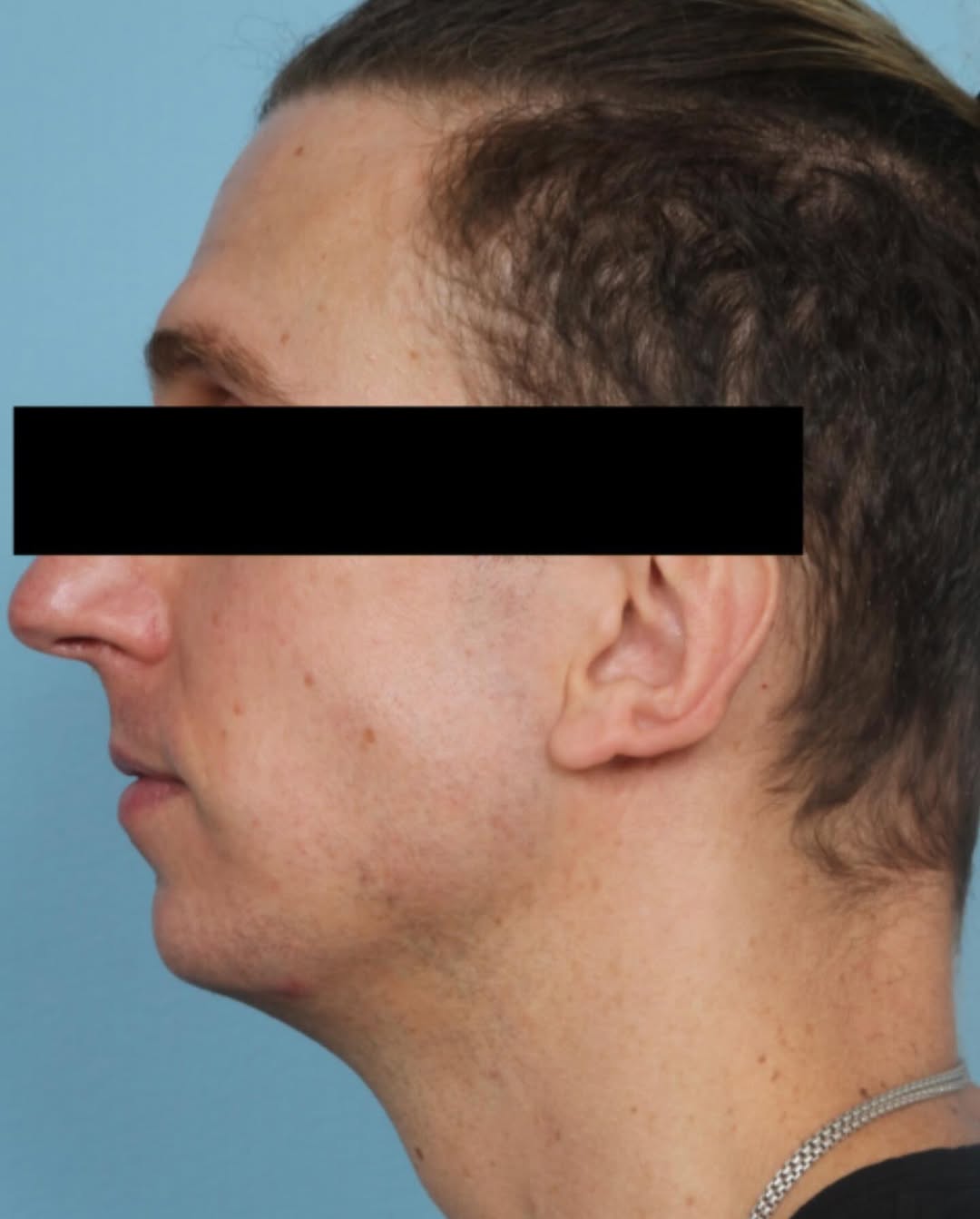 Instagram post by Dr. Marco Ellis: Creating facial harmony. A more defined chin can be both subtle and impactful. #northwesternplasticsurgery #chicagoplasticsurgery