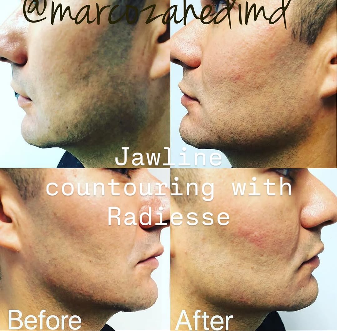 Instagram post by Dr. Marco M. Zahedi: Jawline countouring is such an under discussed topic. The second most important structures of the face (cheeks first) to maintain our facial…