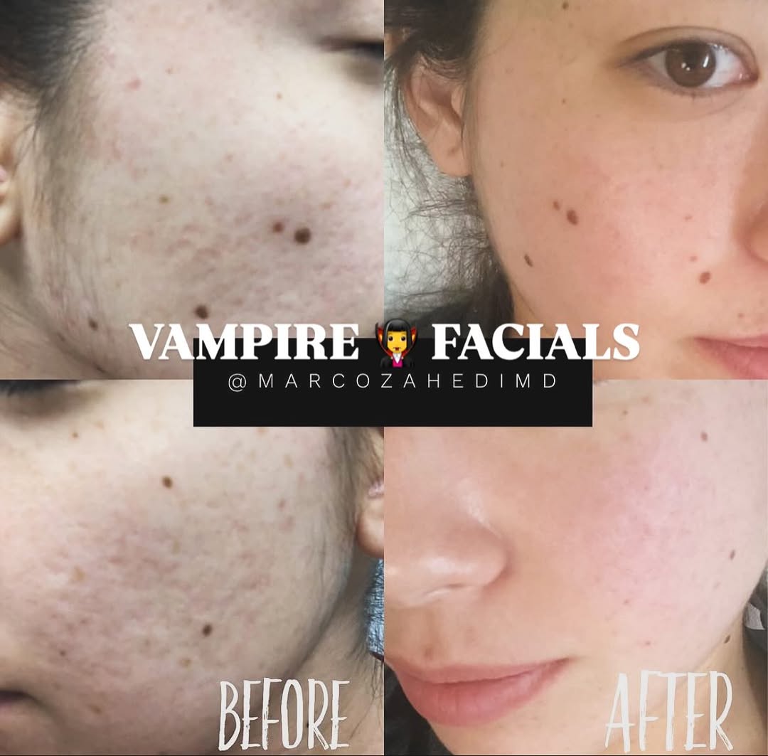 Instagram post by Dr. Marco M. Zahedi: Get your Platelet Rich Plasma (PRP) aka Vampire Facial special for our annual Halloween discount - For your 15% off package of 2 facials, us…