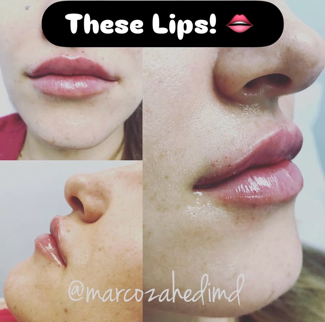 Instagram post by Dr. Marco M. Zahedi: Post Juvederm lip filler. We can help you achieve your lip goals whether it’s natural looking volume enhancement, slow and gradual reversal …