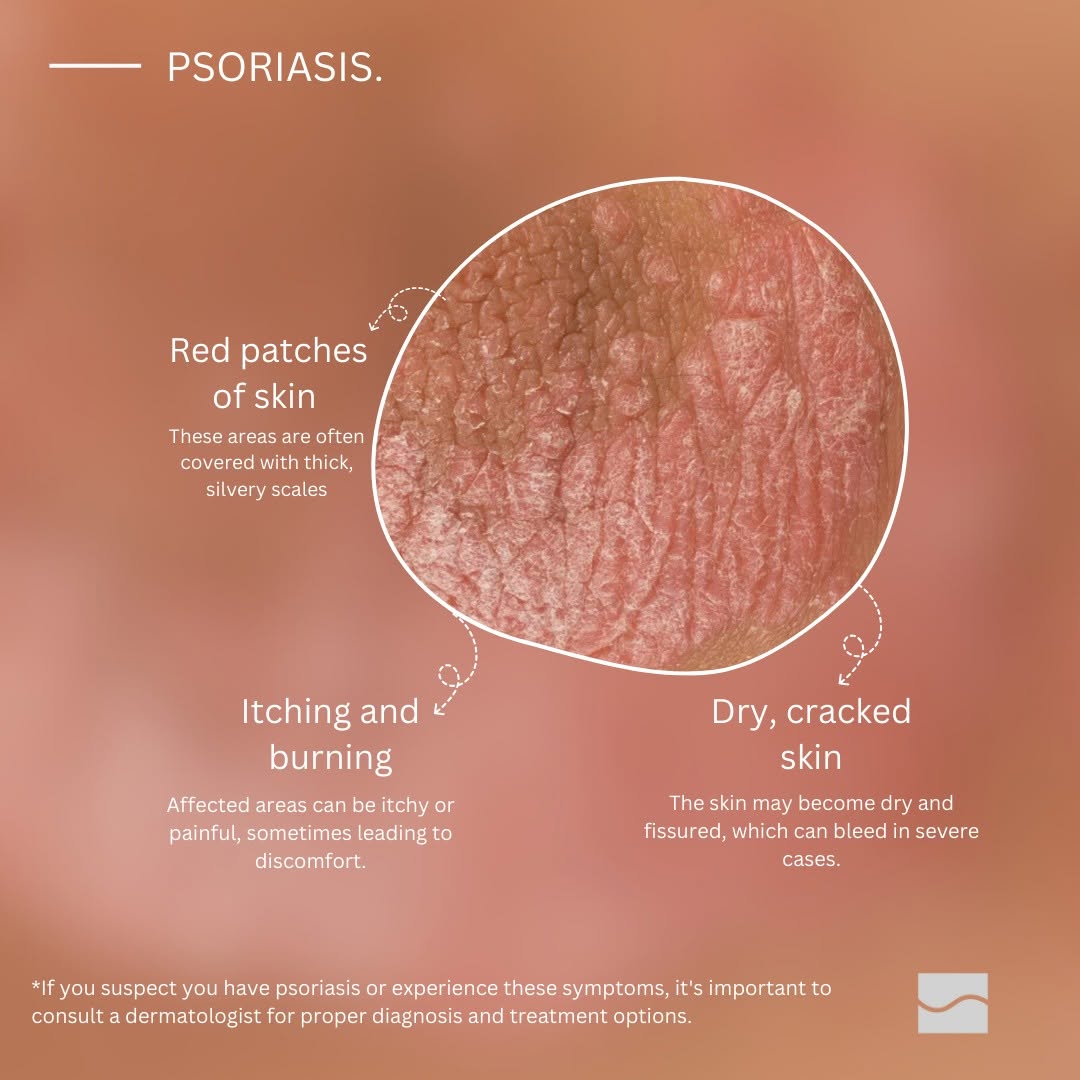 Instagram post by Dr. Marcy Alvarez: If you suspect you have psoriasis or experience these symptoms, it's important to consult a dermatologist for proper diagnosis and treatment…