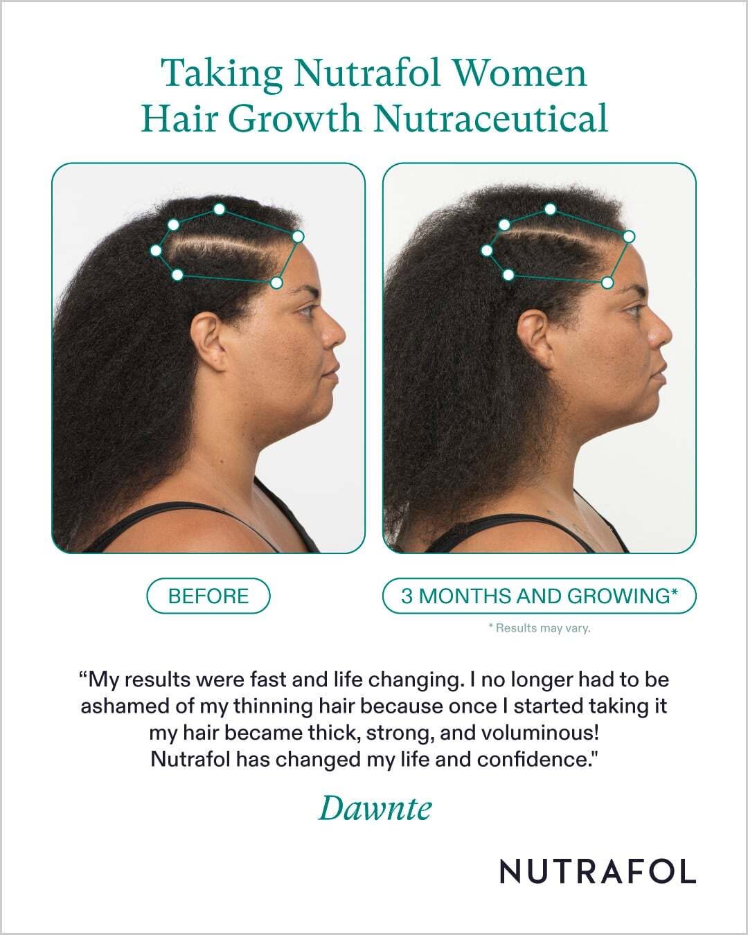 Instagram post by Dr. Margaret Weiss: See for yourself why Nutrafol is the #1 dermatologist-recommended hair growth supplement brand. For one more week, enjoy 20% off The Ultimat…