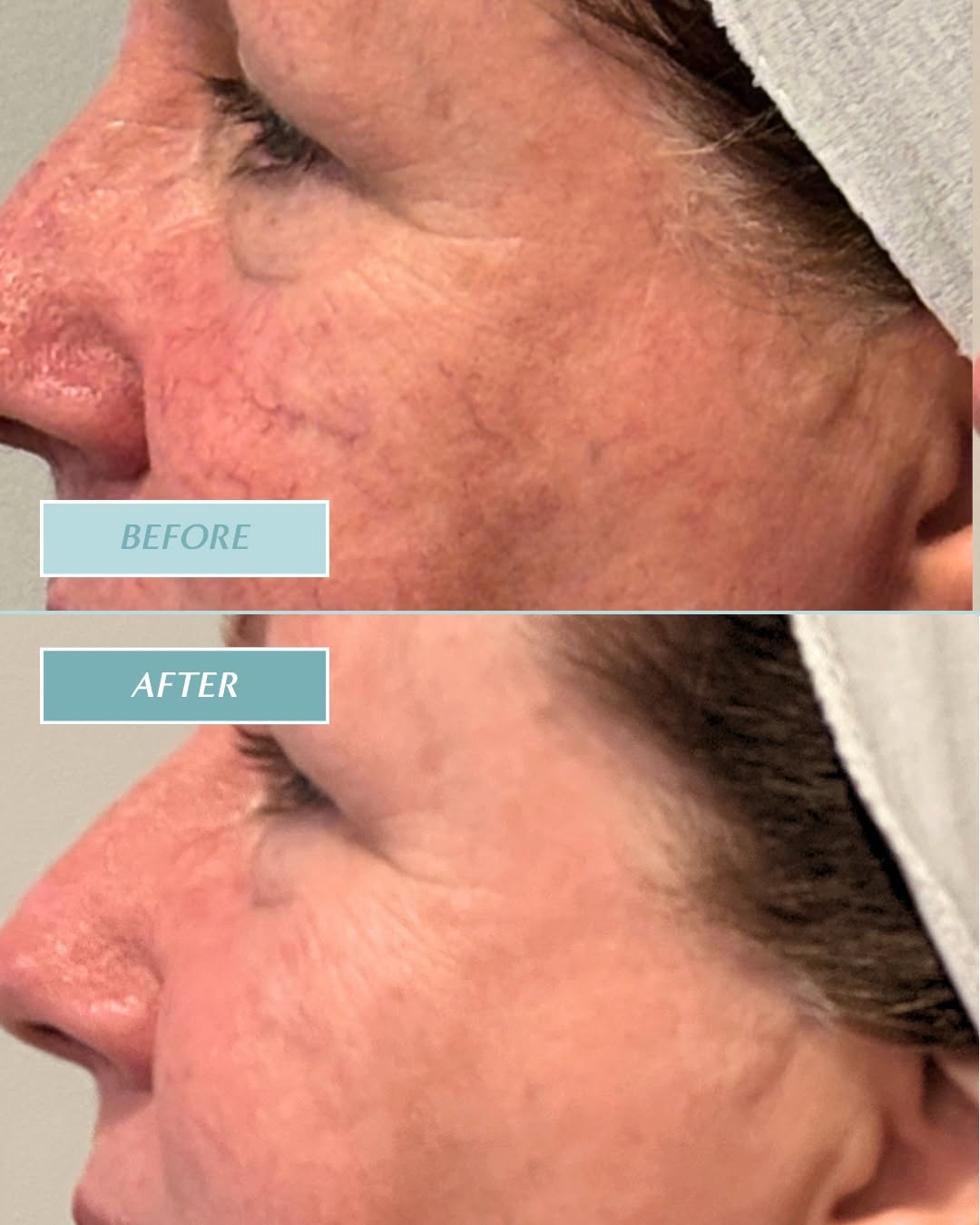 Instagram post by Dr. Margo Weishar: Small veins. Big difference. This before + after showcases the improvement possible with treatment for visible facial spider veins. By targe…