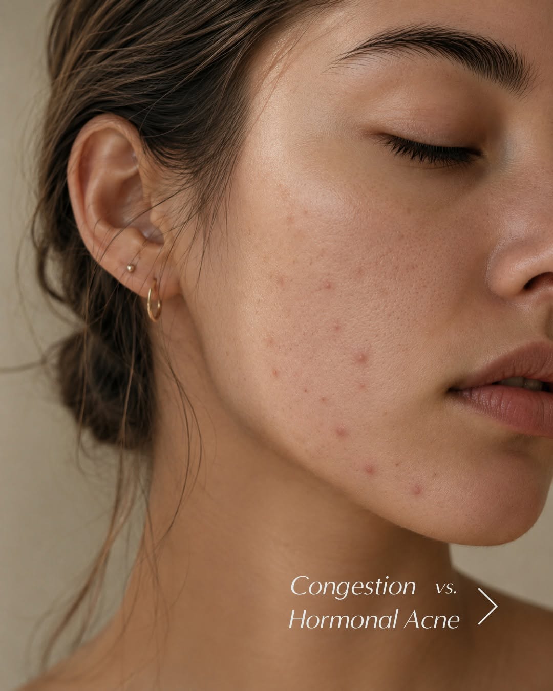 Instagram post by Dr. Margo Weishar: Not every breakout is acne—and not every acne treatment works for every breakout. Hormonal acne and skin congestion can look surprisingly si…