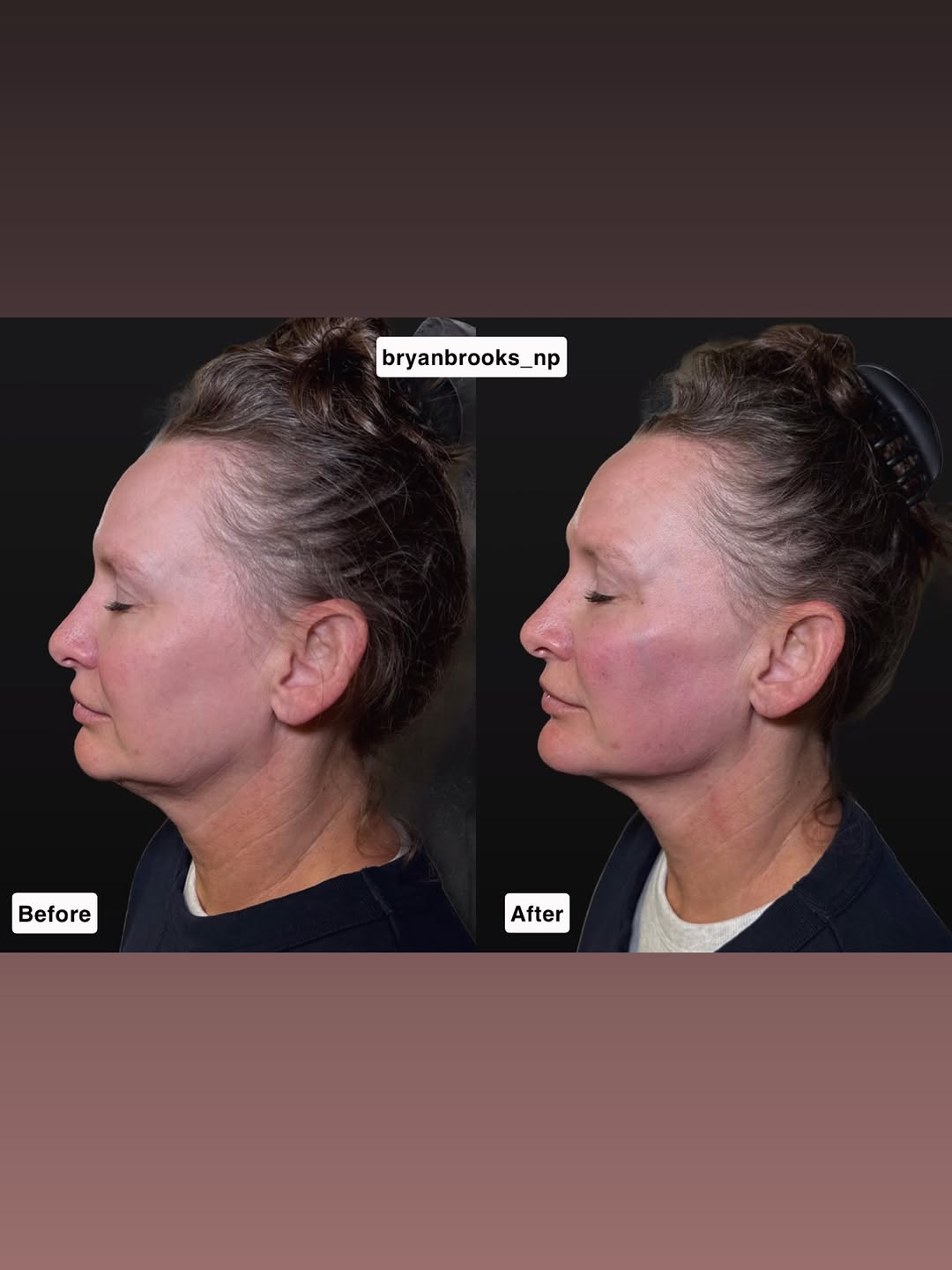 Instagram post by Dr. Marguerite E. Aitken: ✨ The Grand Pearl Signature Liquid Facelift This beautiful before & after was created using the MD Codes technique, which I had the privileg…