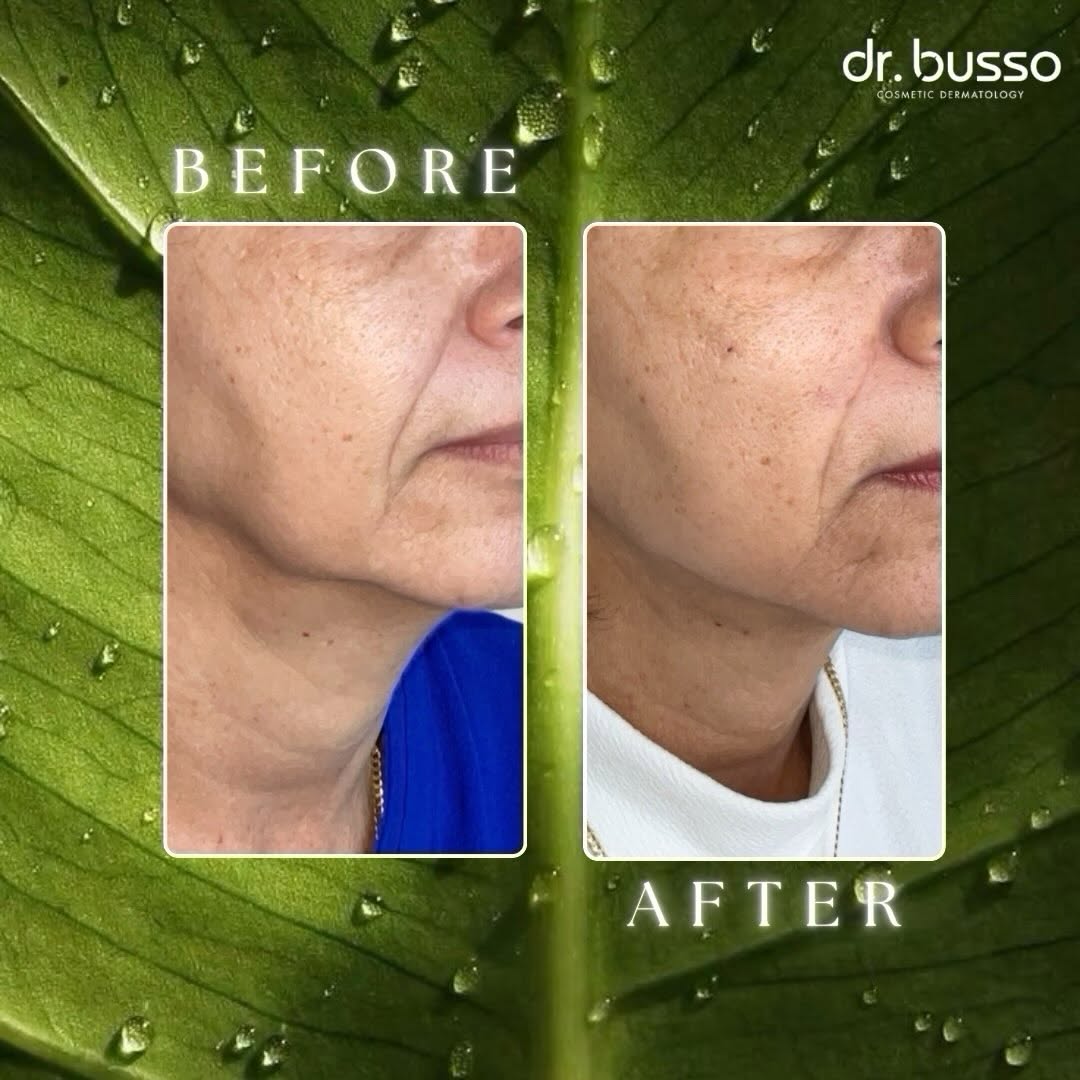 Instagram post by Dr. Mariano Busso: Facial aging is not just about lines—it’s about changes in structure, support, and volume distribution. With the right approach, we can help…