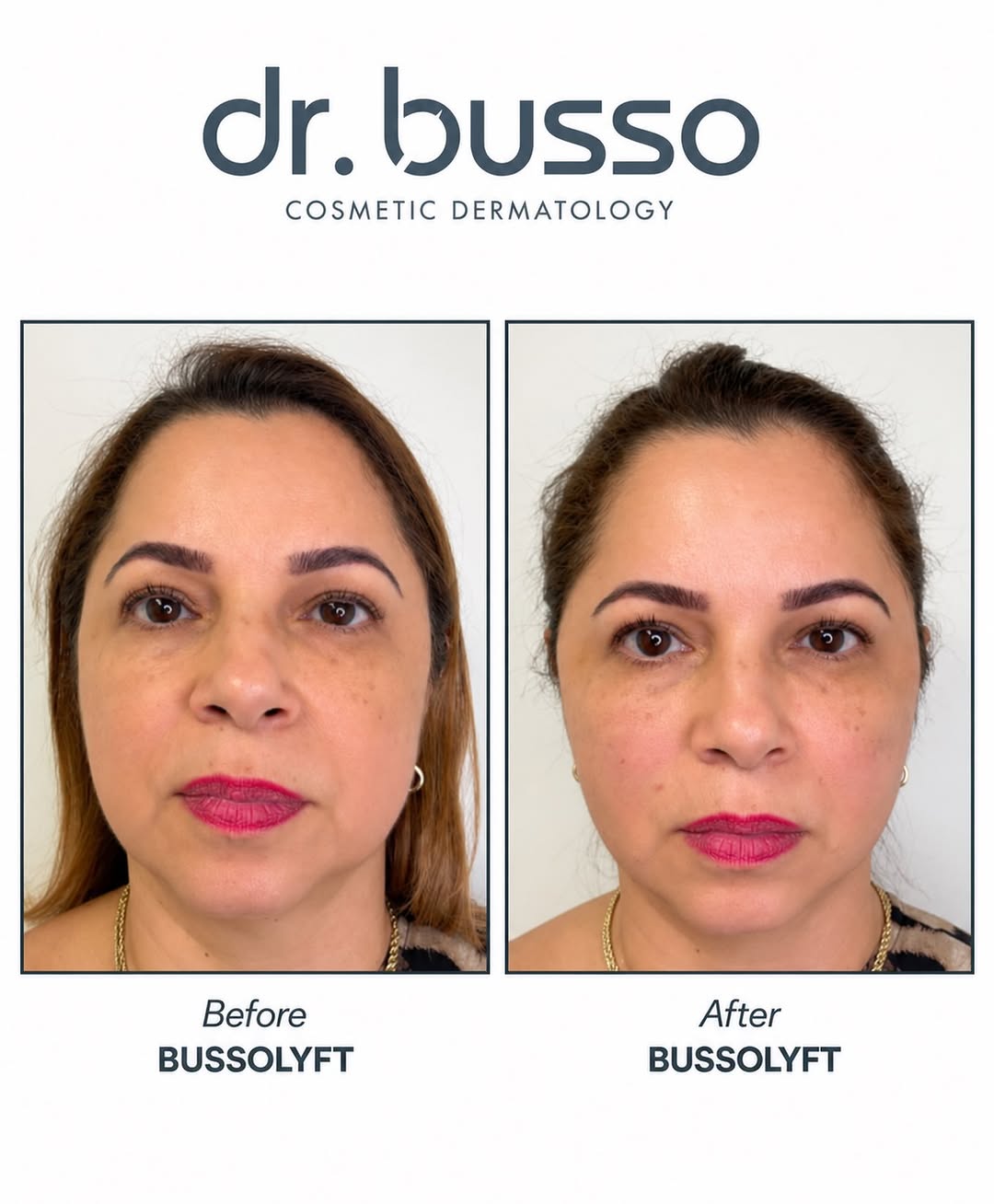 Instagram post by Dr. Mariano Busso: The signature BussoLyft works to reposition fat pads and restores your overall structure, giving you a more youthful and refreshed appearanc…