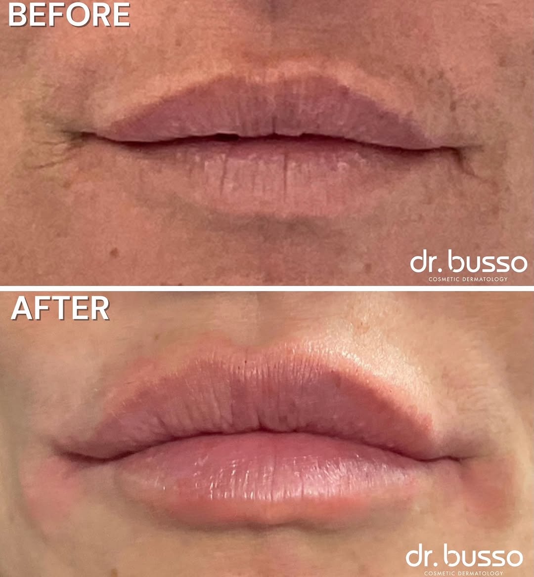 Instagram post by Dr. Mariano Busso: For this lip filler treatment, Dr. Busso focused on enhancing the lips shape while keeping the result soft and natural looking. Every treatm…