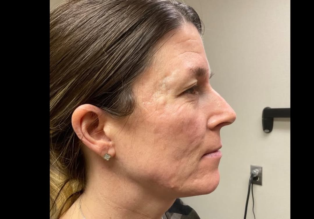 Instagram post by Dr. Marina Buckley: ✨ Real Results. Real Confidence. ✨ Acne scars can be a lasting reminder of breakouts long after the acne is gone—but with the right combinat…