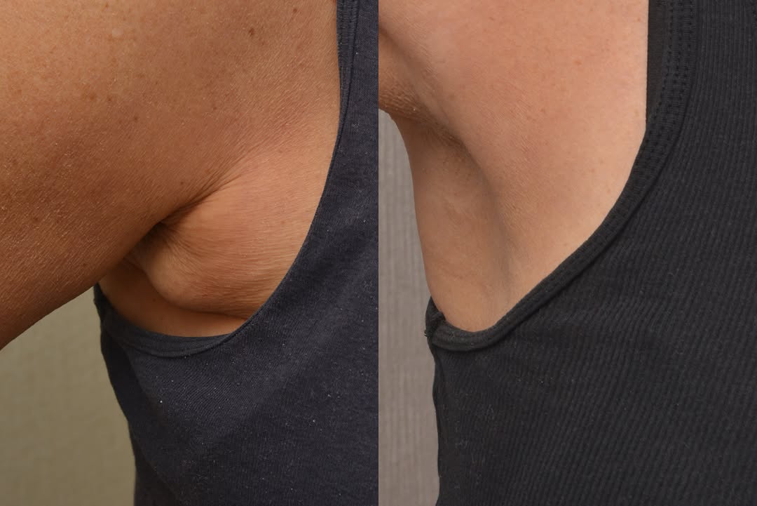Instagram post by Dr. Marina Buckley: ✨ Amazing Transformation Alert! ✨ This incredible before & after showcases the power of an Axillary Tuck (Axilloplasty), also known as an Ar…