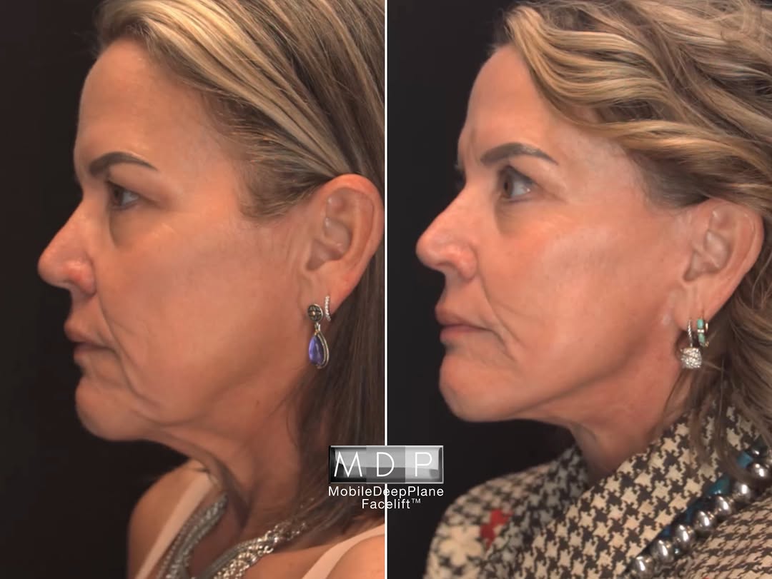 Instagram post by Dr. Mark A. Deuber: One year later, and the results speak for themselves. ✨ 12 months after saying YES to rejuvenating FACE + EYES with @drmarkdeuber, this pati…