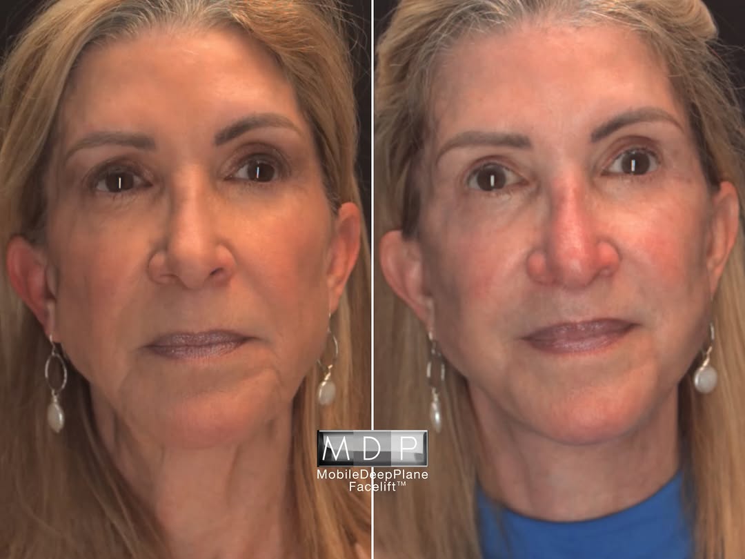 Instagram post by Dr. Mark A. Deuber: Promises are easy. Results are not. Only two months post-op, this #MobileDeepPlane Facelift™ patient is already experiencing results that sp…