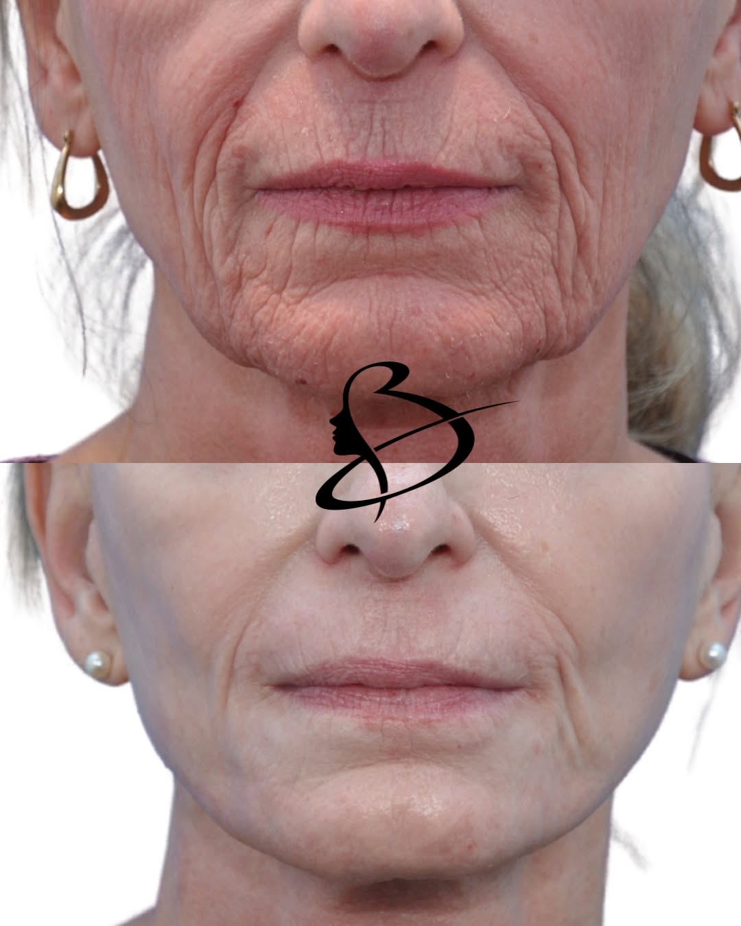 Instagram post by Dr. Mark Beaty: Those little lines around the mouth? They’re rarely a one-treatment fix. Softening perioral lines usually takes a customized combination app…