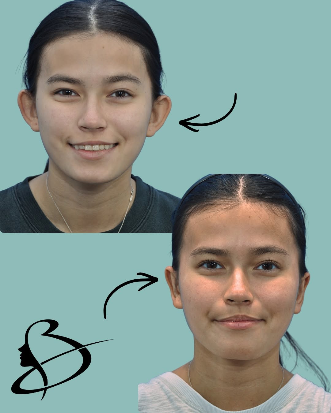 Instagram post by Dr. Mark Beaty: Ears that blend naturally into your features can make a remarkable difference in overall facial harmony. 👂✨ This otoplasty result delivers …