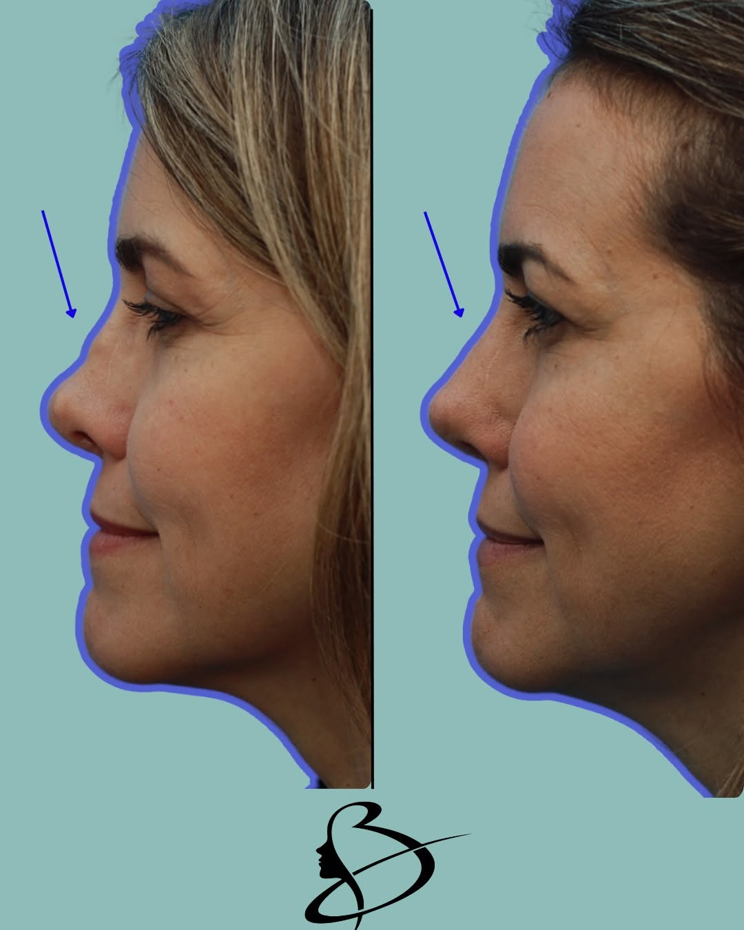 Instagram post by Dr. Mark Beaty: A revision rhinoplasty isn't just about changing the nose—it's about restoring confidence, function, and balance after a previous surgery. R…