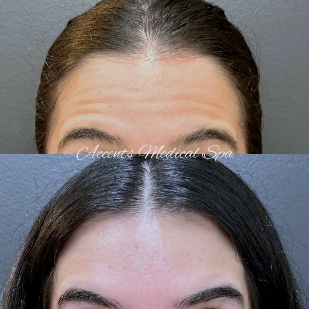Instagram post by Dr. Mark Berkowitz: Smooth, refreshed & still YOU.✨ This before & after shows the difference DAXXIFY™ can make on forehead lines and crow’s feet-softening the a…