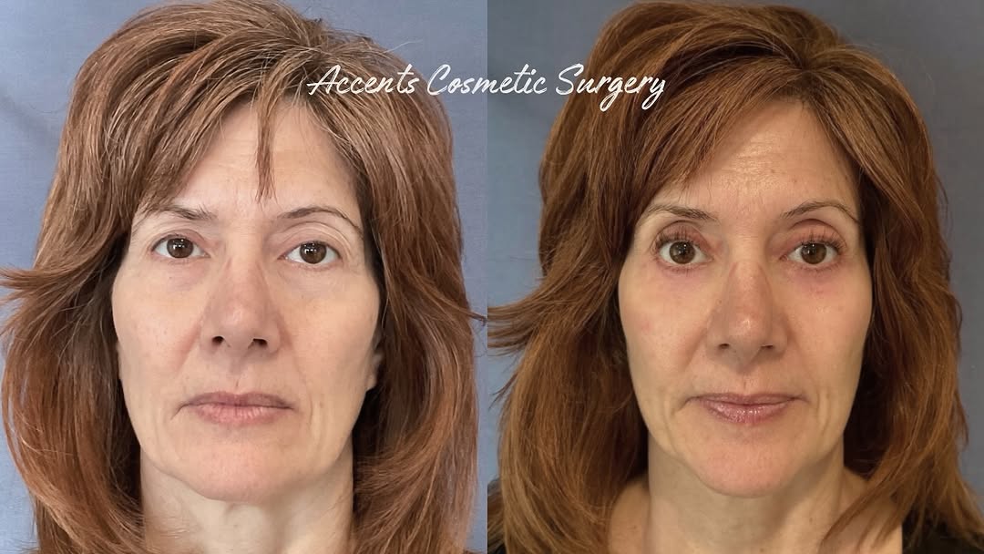 Instagram post by Dr. Mark Berkowitz: ✨ Refreshed, lifted, and still completely natural. This before & after shows the power of combining a brow lift + lower lid blepharoplasty w…