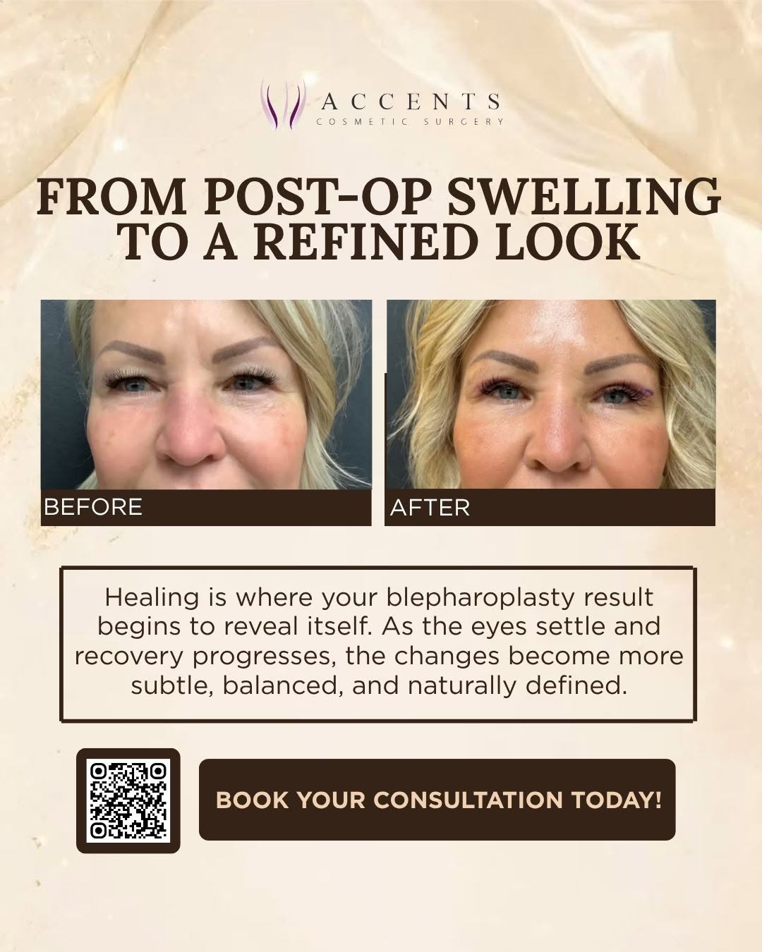 Instagram post by Dr. Mark Berkowitz: ✨ YOUR FINAL RESULT TAKES TIME TO UNFOLD. Blepharoplasty recovery is a gradual process. As swelling decreases and the delicate eye area cont…