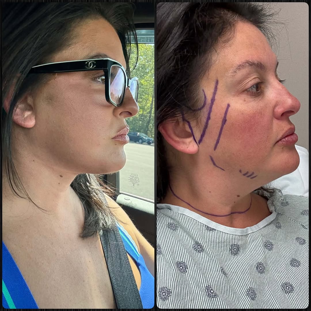 Instagram post by Dr. Mark Clymer: ✨SWIPE✨ to see this gorgeous patient’s progress at only FIVE weeks. She already looks refreshed, sculpted, and naturally lifted without look…