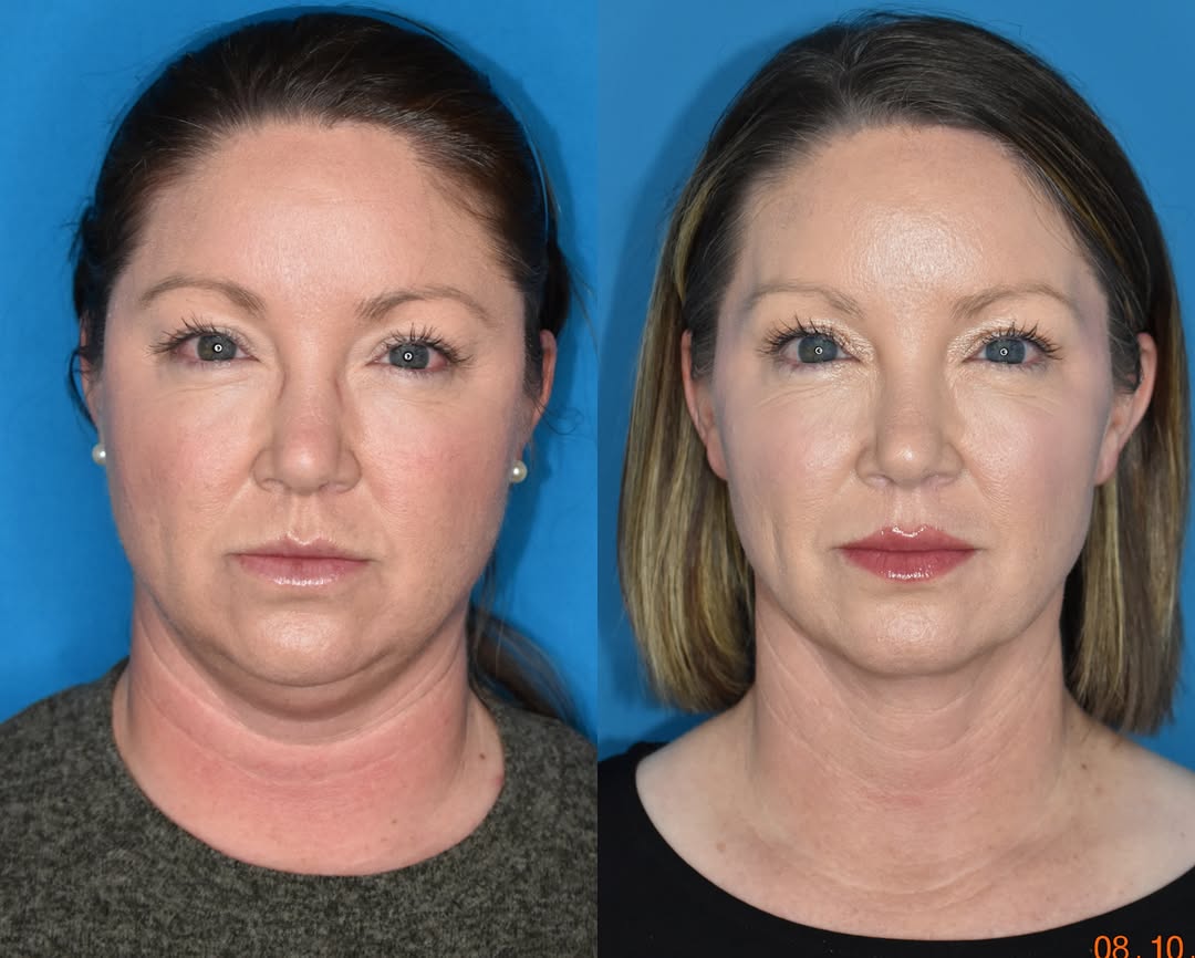 Instagram post by Dr. Mark Clymer: 2 years post-op from her neck contouring procedure, our PCA’s before & after photos are AMAZING! #neckcontour #snatched