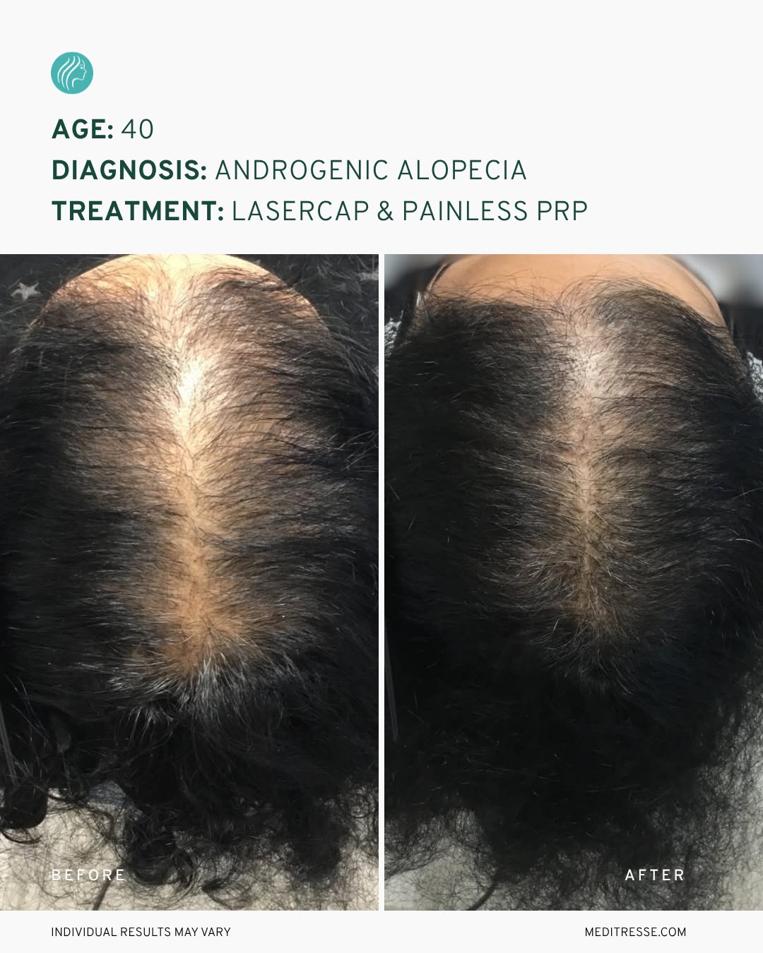 Instagram post by Dr. Mark DiStefano: A widening part is one of the most common signs of female pattern hair loss — but knowing why it’s happening is what determines what comes n…