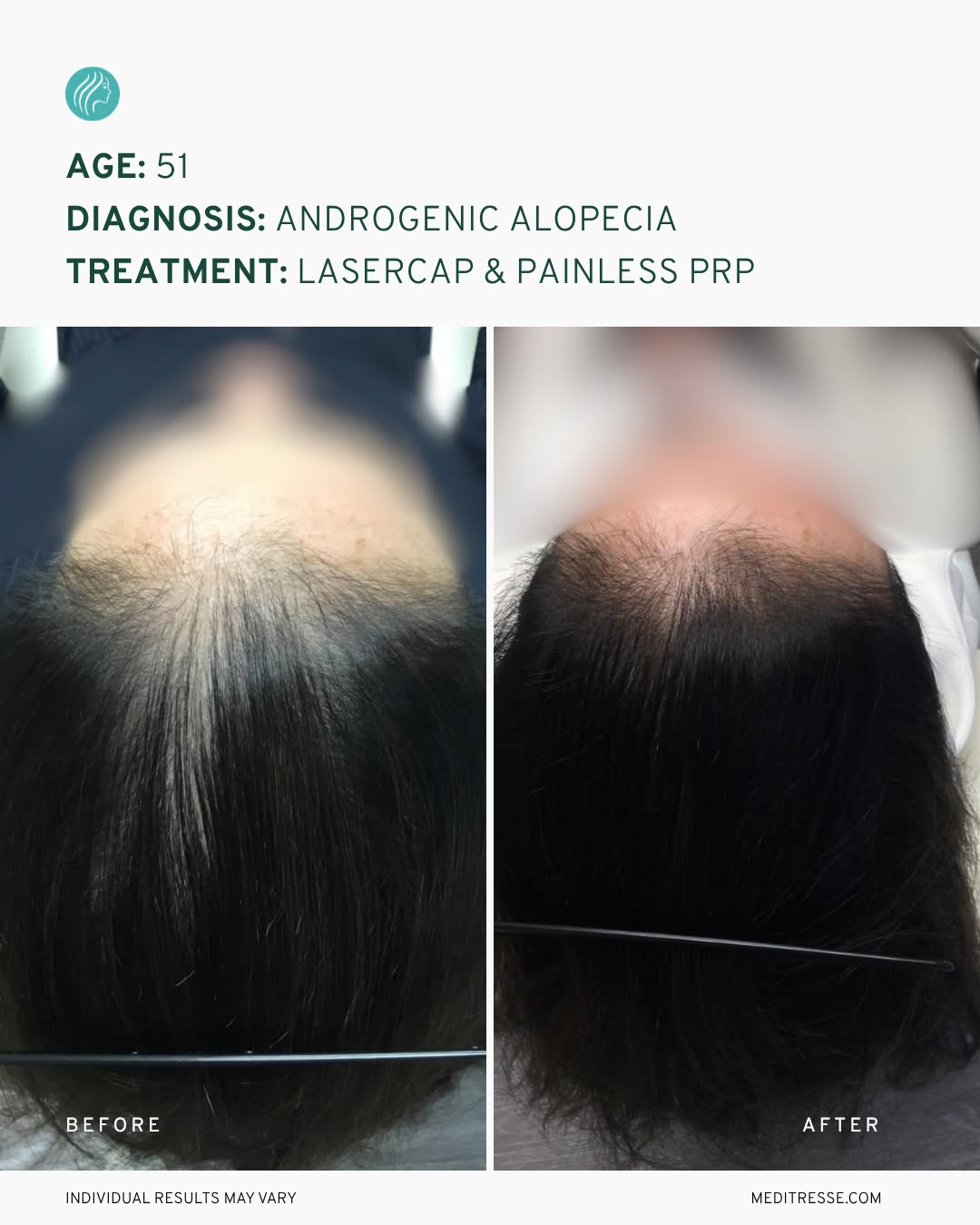 Instagram post by Dr. Mark DiStefano: Female pattern hair loss doesn’t always look like a widening part.⁠ ⁠ For this 51-year-old patient, androgenetic alopecia presented as a rec…