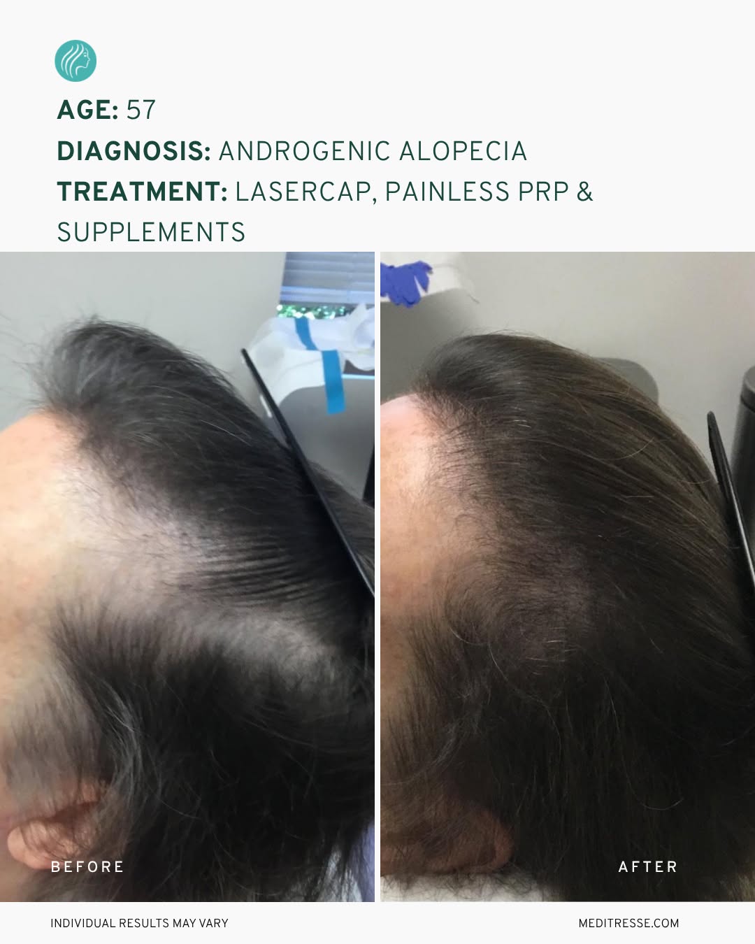 Instagram post by Dr. Mark DiStefano: Hair loss treatment works best when we look at the whole picture.⁠ ⁠ This 57-year-old patient came to Medi Tresse with androgenetic alopecia…
