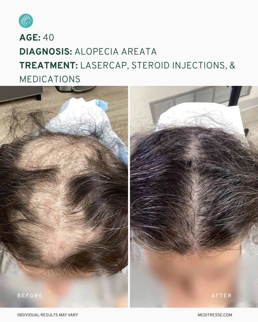 Instagram post by Dr. Mark DiStefano: Alopecia areata can cause significant hair loss, sometimes seemingly out of nowhere. But what’s actually happening beneath the surface?⁠ ⁠ A…