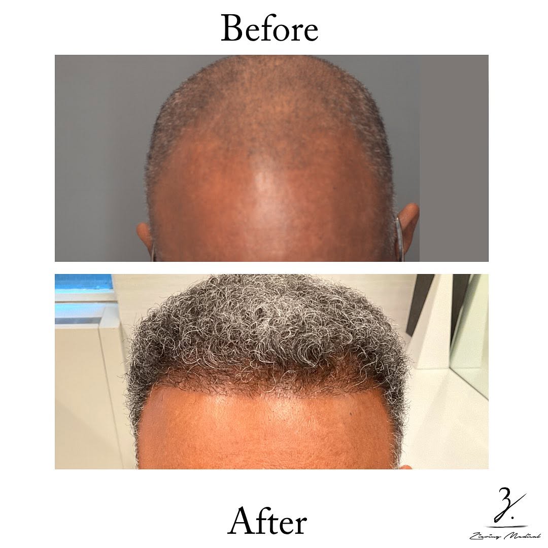 Instagram post by Dr. Mark Faucher: Dr. Faucher performed a 1700 graft FUE hair transplant on his patient to restore his receding hairline and rebuild his temporal peaks. Book …