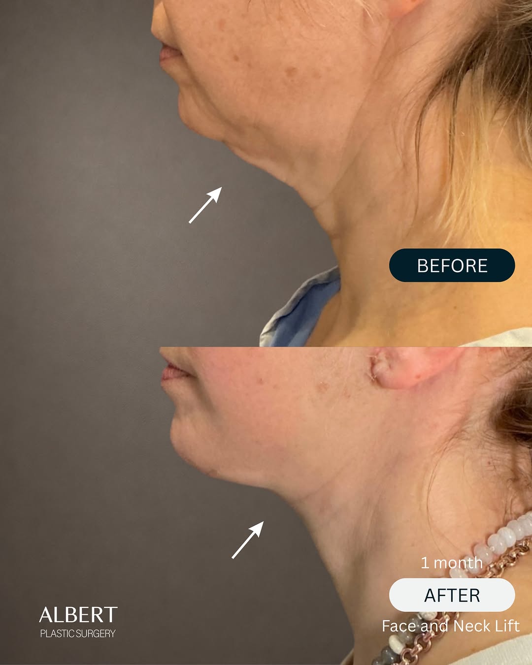 Instagram post by Dr. Mark G. Albert: Just 1 month post-op from a Face & Neck Lift — and already a beautiful improvement in the jawline and neck contour. At this early stage, swe…