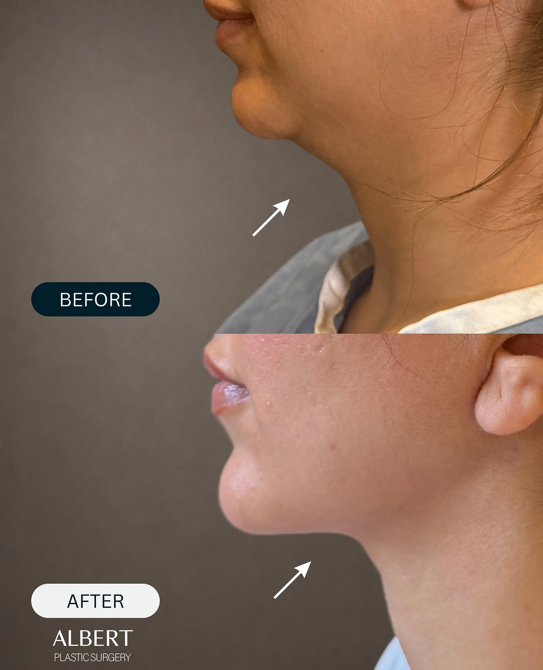 Instagram post by Dr. Mark G. Albert: This Neck Lift + NanoLift result restores definition along the jawline and neck while subtly lifting the cheeks for a refreshed, balanced ap…