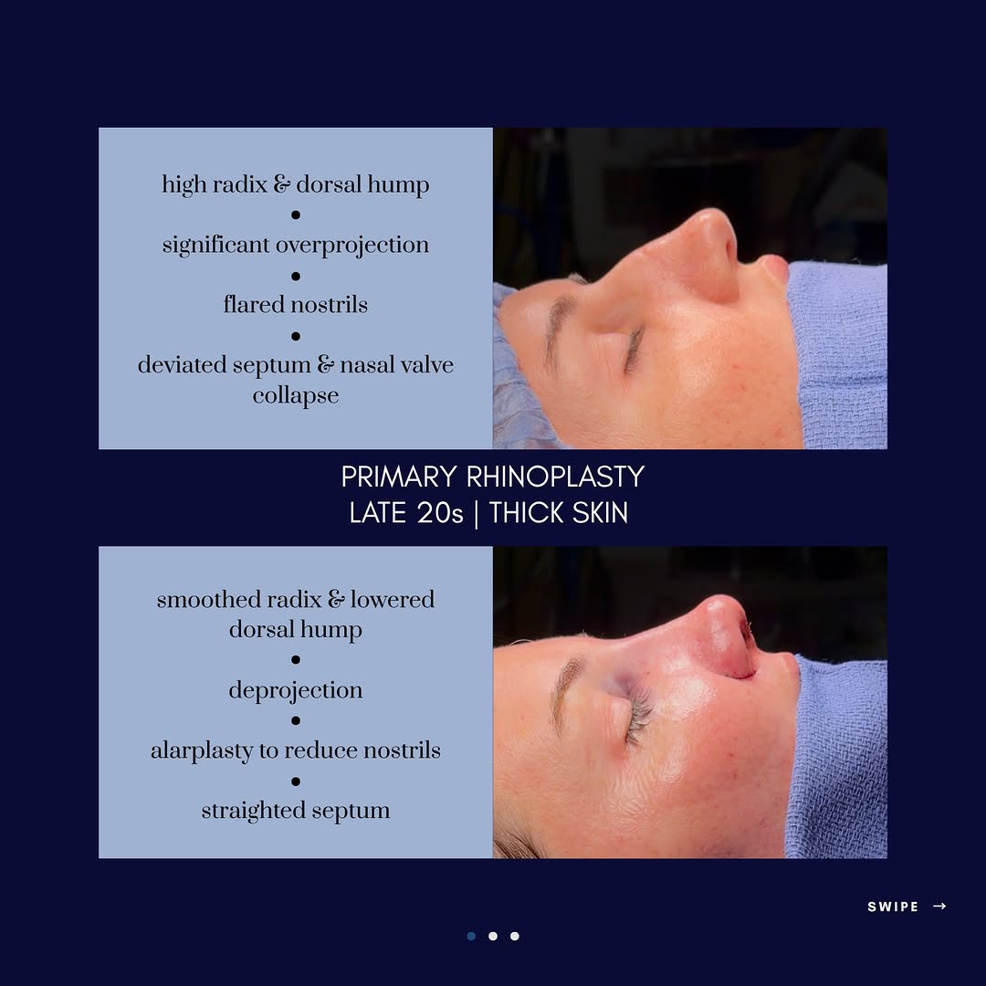Instagram post by Dr. Mark Ginsburg, DO: Rhinoplasty Case Cards: 3 unique patients and 3 unique surgeries 🌟 1️⃣ Primary rhinoplasty with thick skin Dr. Mark Ginsburg Board Certifie…