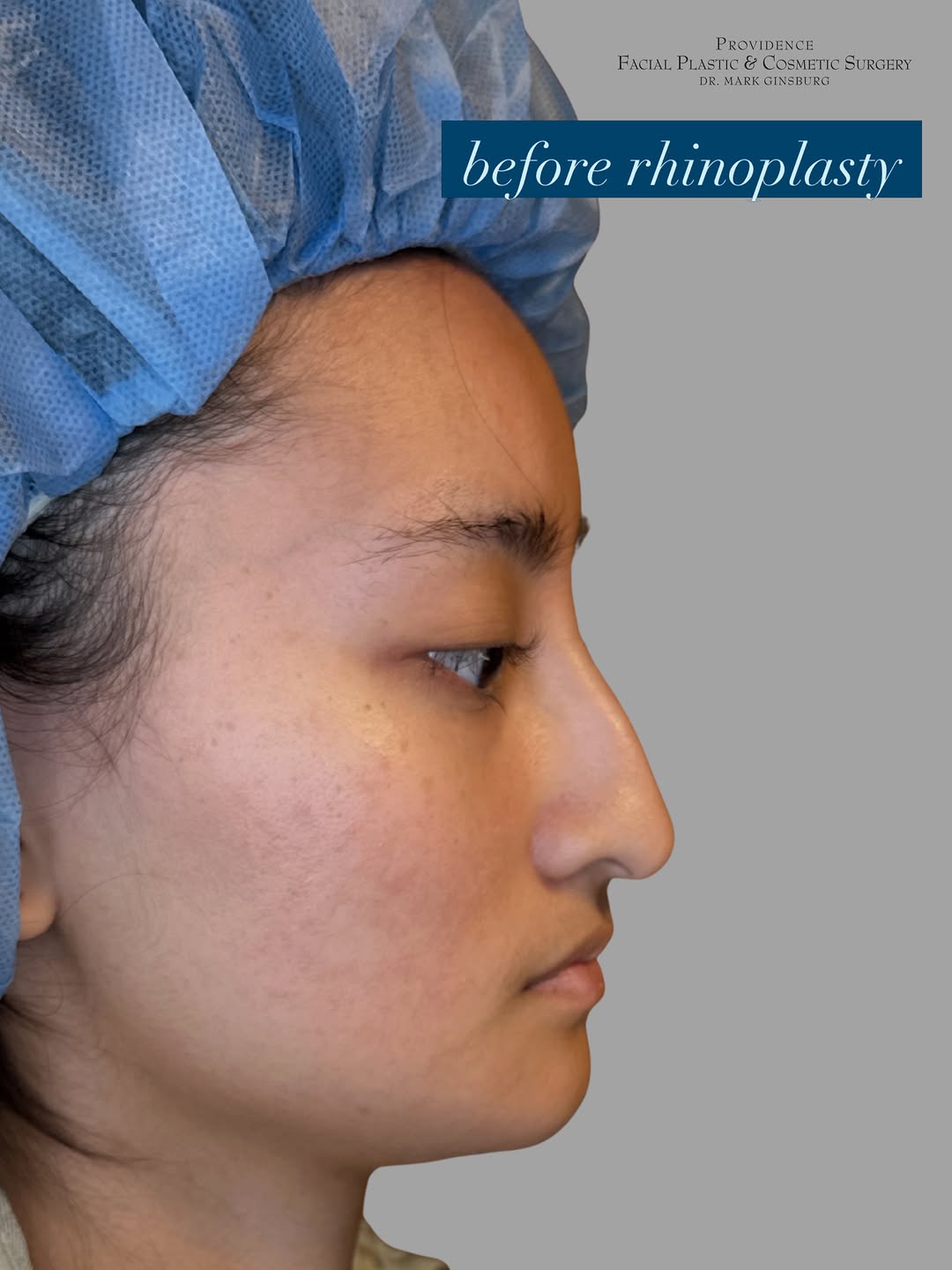 Instagram post by Dr. Mark Ginsburg, DO: Everyone heals at a different rate after a rhinoplasty. It’s typical that the major swelling resolves over the first 3 months after surgery,…