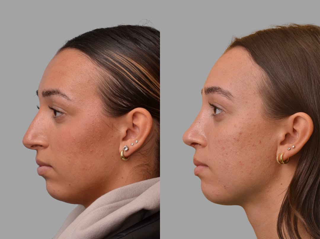 Instagram post by Dr. Mark Ginsburg, DO: One year after rhinoplasty …👃🏼👏🌟🎉 #rhinoplasty #rhinoplastyresults #philadelphiaplasticsurgery #rhinoplastyexpert #recovery Dr. Mark Gi…