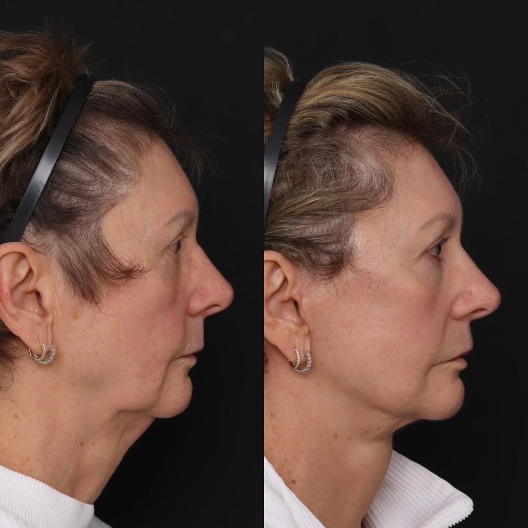Instagram post by Dr. Mark Glasgold: “I would do this again in a heartbeat.” Cheryl is 4 months out from a deep plane face and neck lift with CO2 laser resurfacing. As a surgeon…