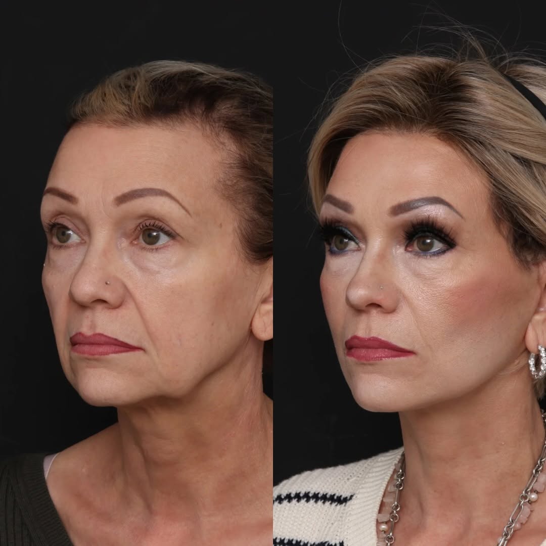 Instagram post by Dr. Mark Glasgold: 1 month after her facelift, and red-carpet ready! While I can’t take credit for Cyndi’s serious makeup skills, I am loving her early results…