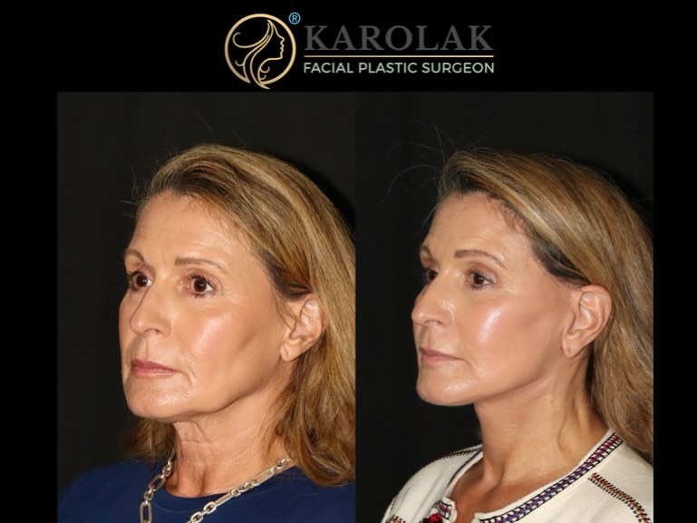 Instagram post by Dr. Mark Karolak: 5 week update! At 61, Karen was already absolutely gorgeous! She came in looking to rebalance her facial features and restore definition to …