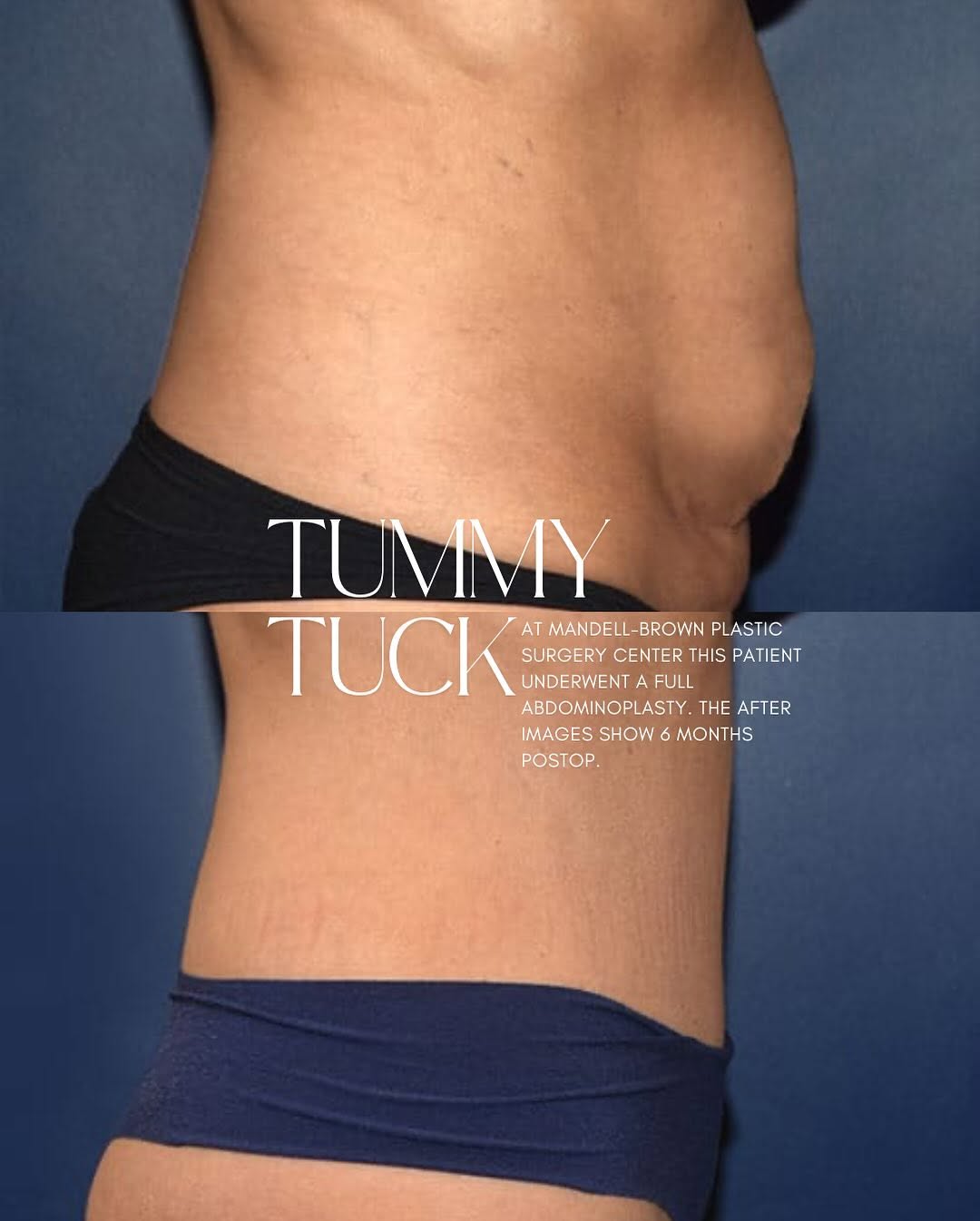 Instagram post by Dr. Mark Mandell-Brown: ✨ Transformation Thursday ! ✨ This stunning before-and-after is proof that confidence looks good on everyone! Our patient underwent a full a…