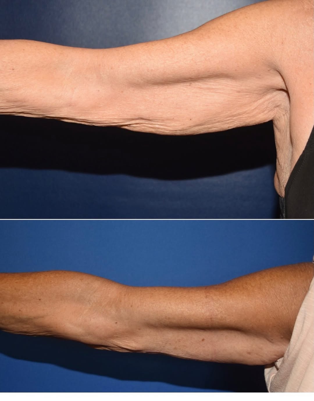 Instagram post by Dr. Mark Mandell-Brown: Dr. Mark Mandell-Brown performed an arm lift to reduce excess skin after weight loss. He can place the incision based on patient preference!…