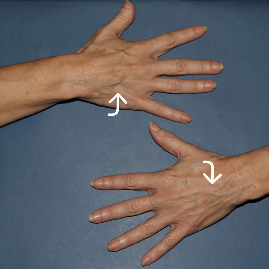 Instagram post by Dr. Mark Rayman: Look and feel youthful with our custom #handrejuvenation #handveins #veins #veintreatment #sclerotherapy #microphlebectomy #veinspecialist #…