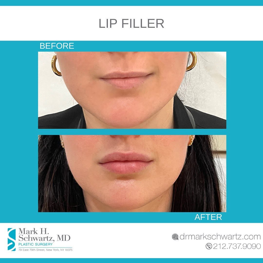 Instagram post by Dr. Mark Schwartz: Who’s ready for this? 👄💉🤫 Lip augmentation with 1 vial of #Juvederm For more information or to schedule a consultation: ☎️212-737-9090 📧…