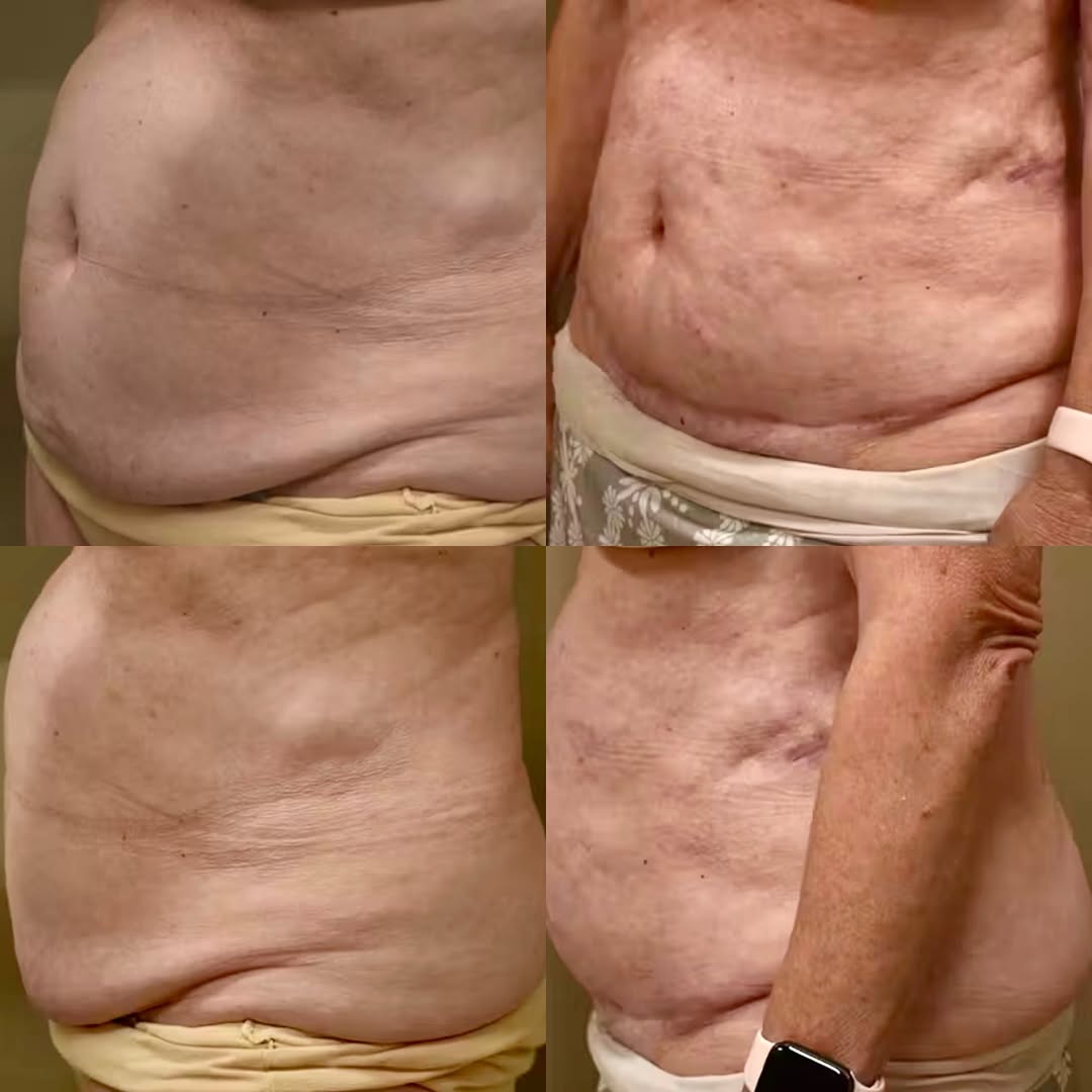 Instagram post by Dr. Mark Sofonio: A smoother, firmer abdomen… and a renewed sense of confidence. ✨ A tummy tuck (abdominoplasty) can do more than remove excess skin - it can …