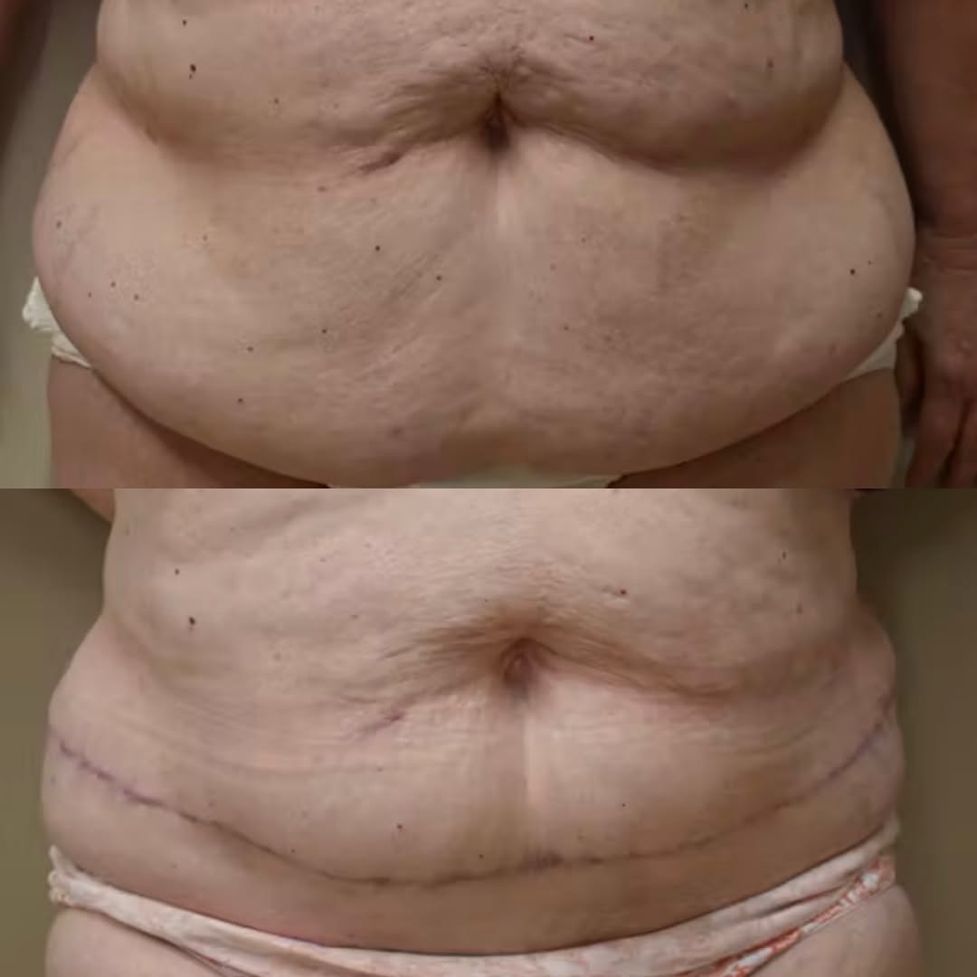 Instagram post by Dr. Mark Sofonio: A tummy tuck doesn’t have to mean an overly tight or “operated” look. ✨ Dr. Sofonio takes a conservative, individualized approach to abdomin…