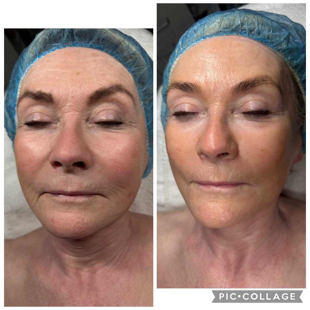 Instagram post by Dr. Mark Sofonio: ✨ Instant refresh. No needles. No downtime. ✨ We’re loving the results from our PRX PLUS treatment! This innovative, needle-free treatment i…