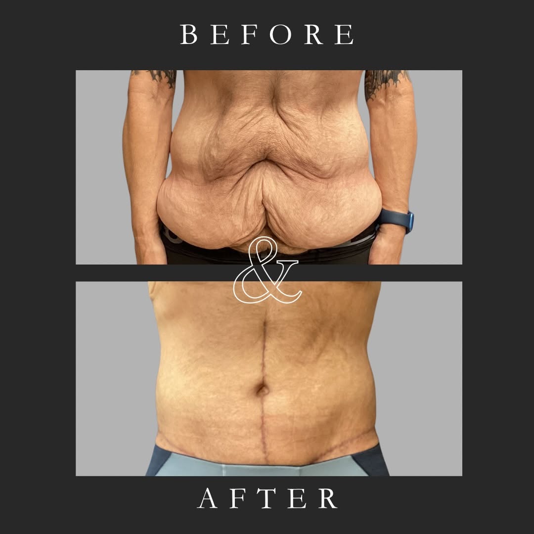 Instagram post by Dr. Mark W. McClung: The hard work doesn’t stop at weight loss, sometimes the journey isn’t complete until excess skin is addressed. This patient underwent a bel…