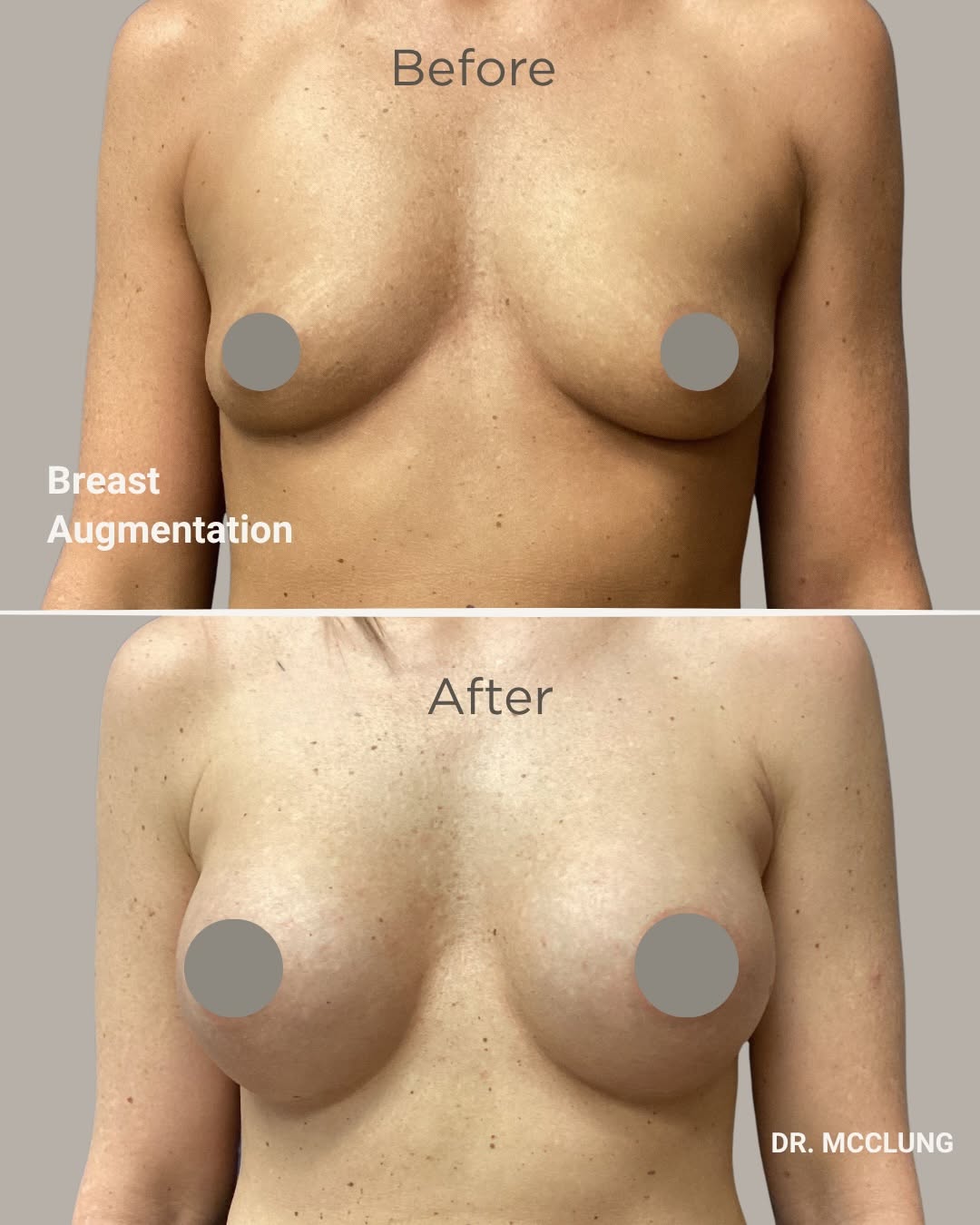 Instagram post by Dr. Mark W. McClung: Breast augmentation isn’t just about increasing size—it’s about creating balance and achieving your personal goals. Every breast augmentatio…